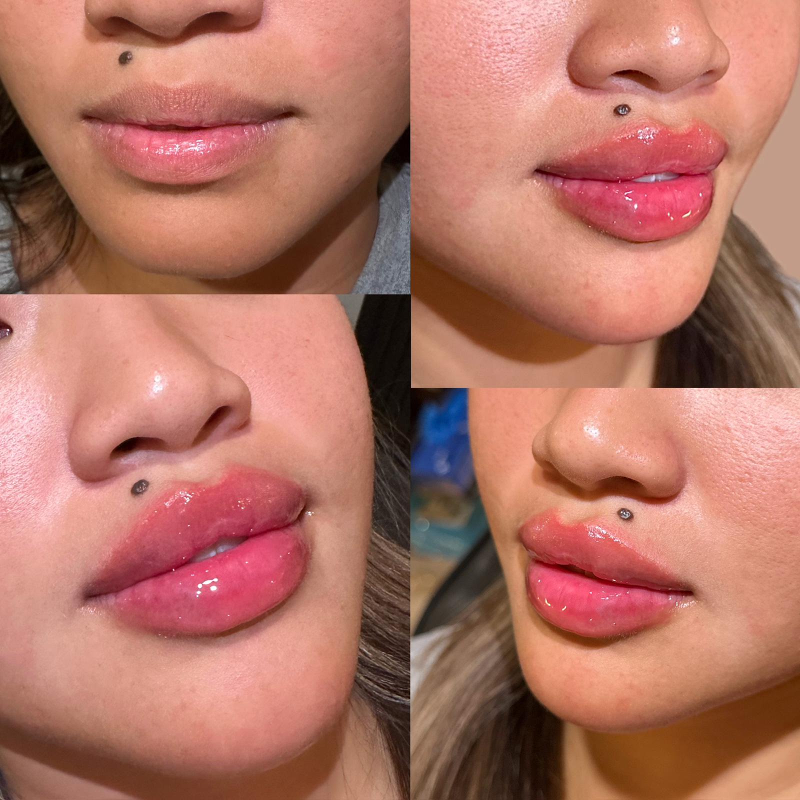 Before and After Lip Filler Treatment