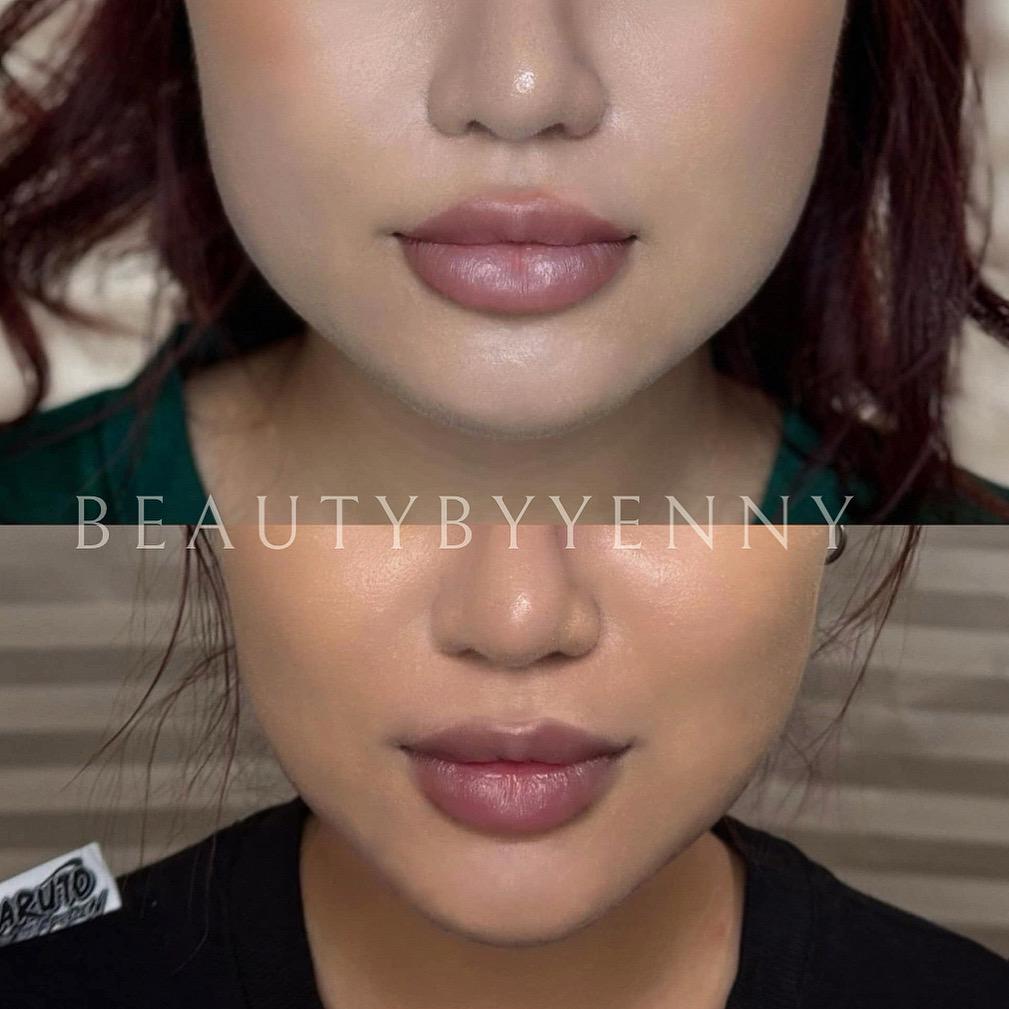 Before and After Masseter Botox Treatment