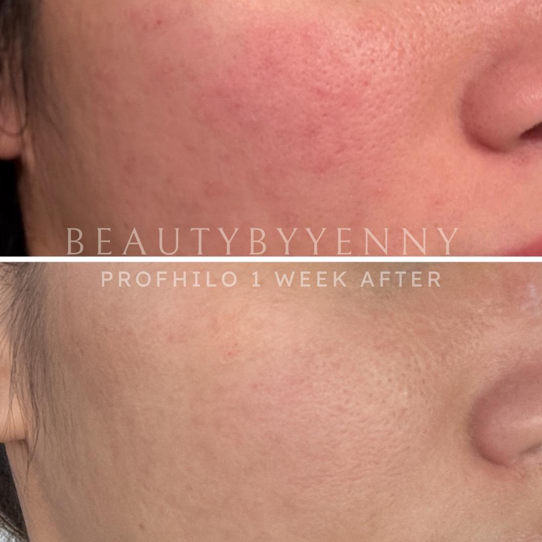 Before and After BAP Profhilo Treatment