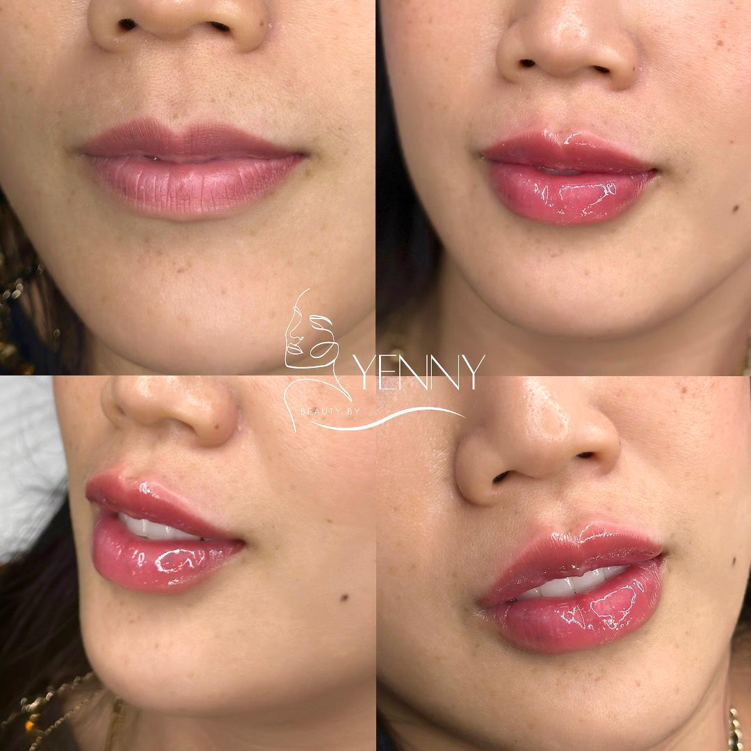 Before and After Lip Filler Treatment