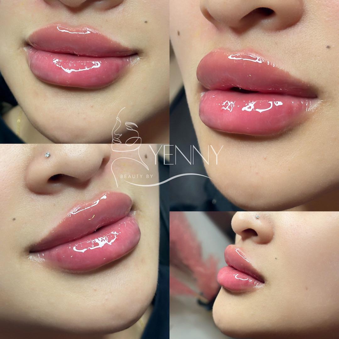 Before and After Lip Filler Treatment