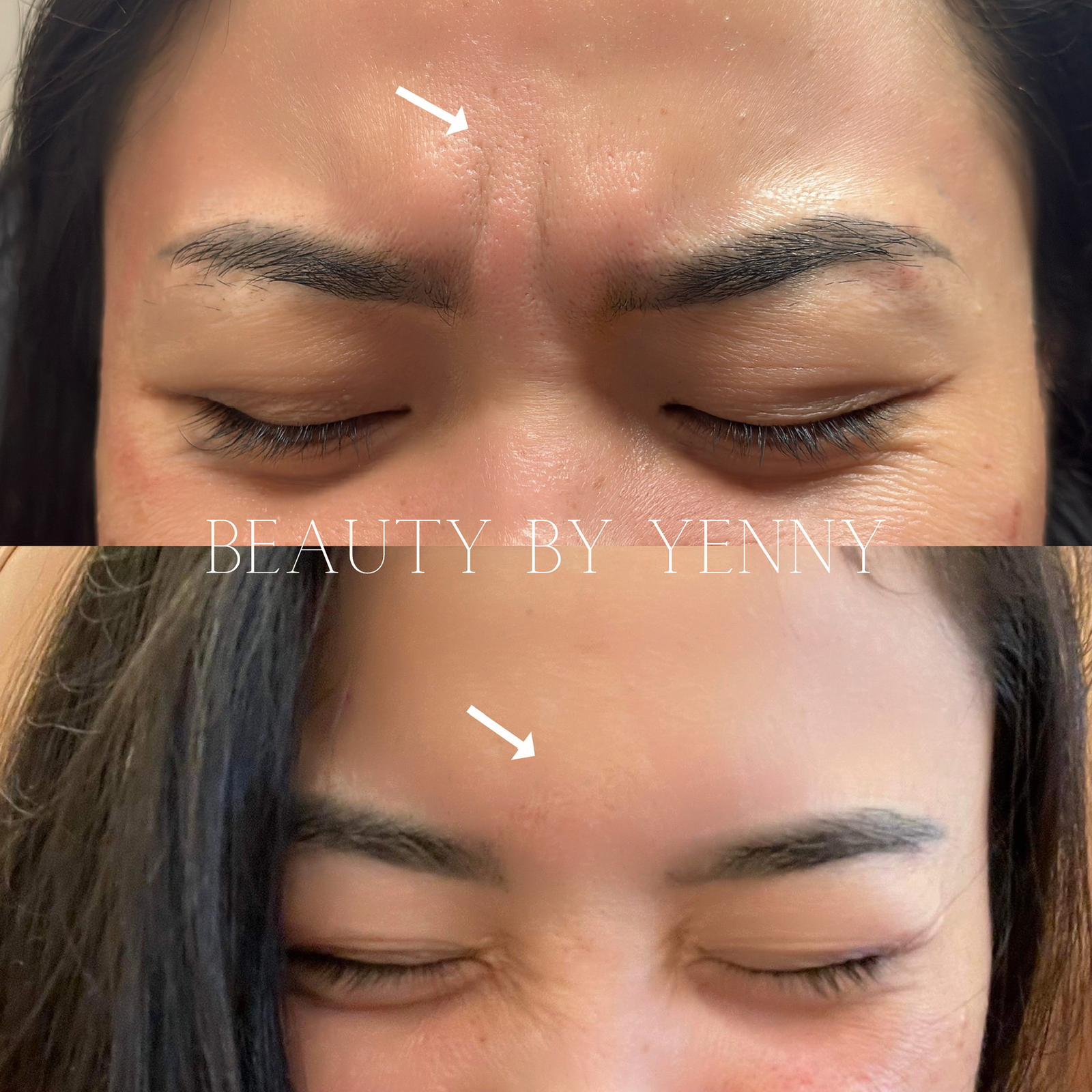 Before and After Botox Treatment