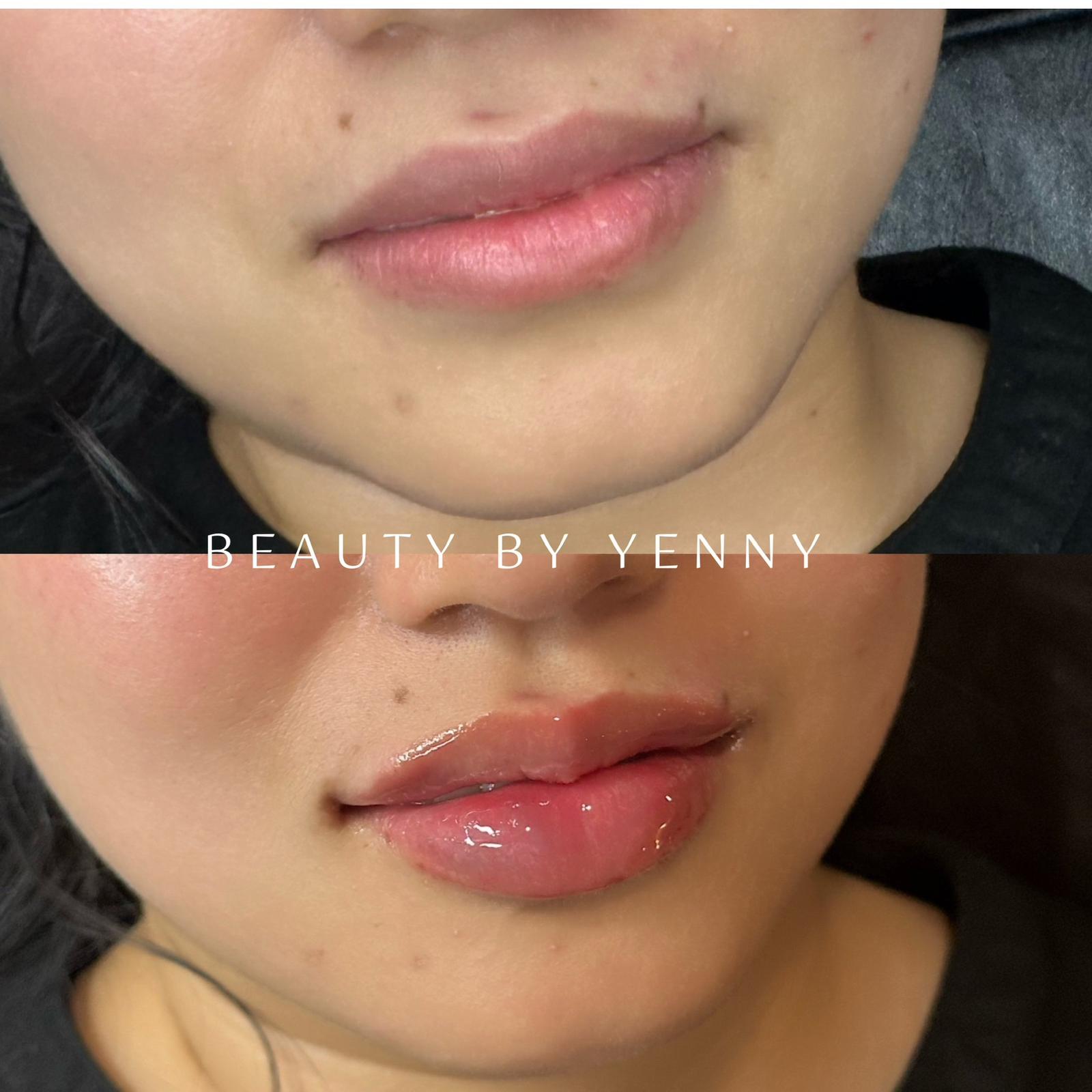 Before and After Lip Filler Treatment