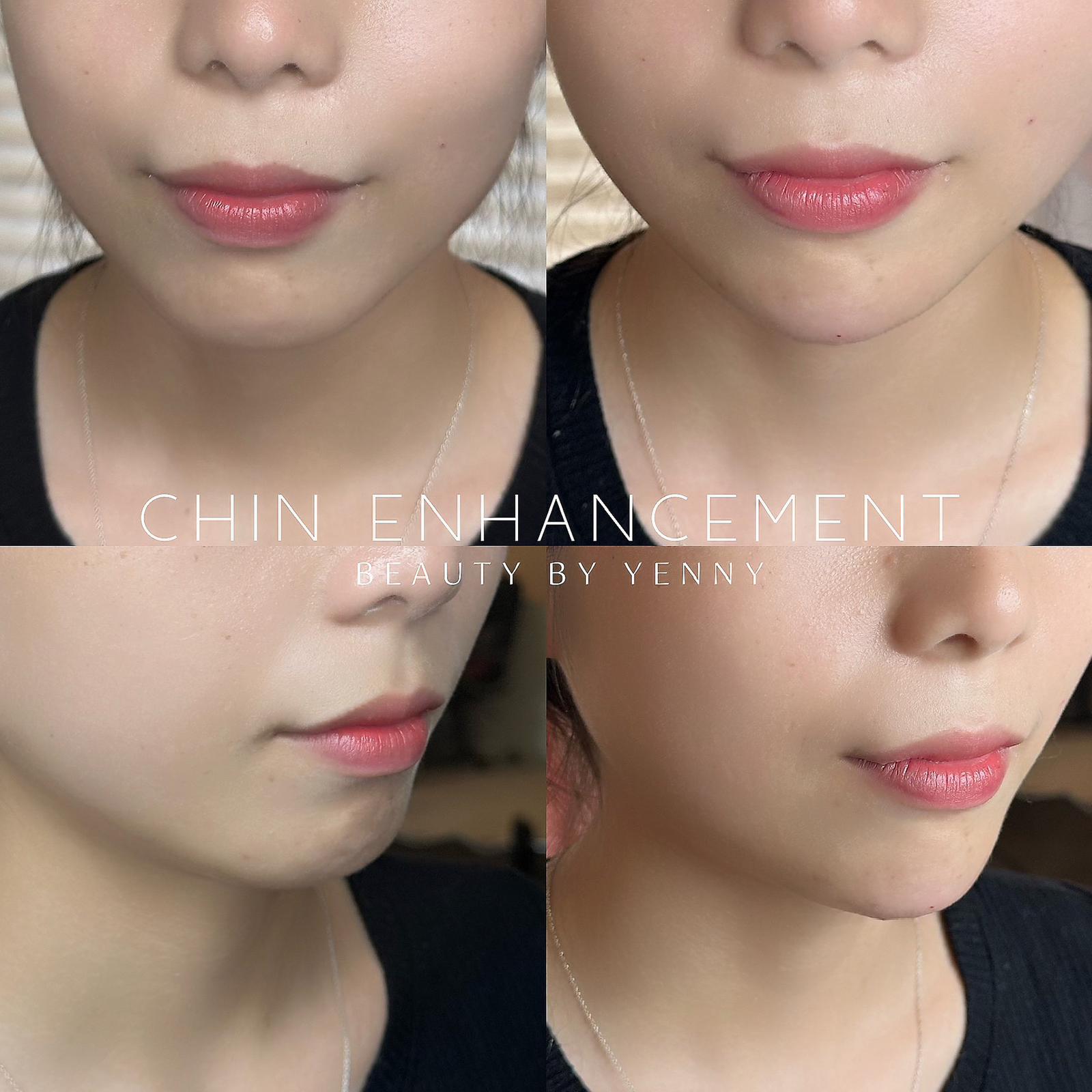 Before and After Chin filler Treatment