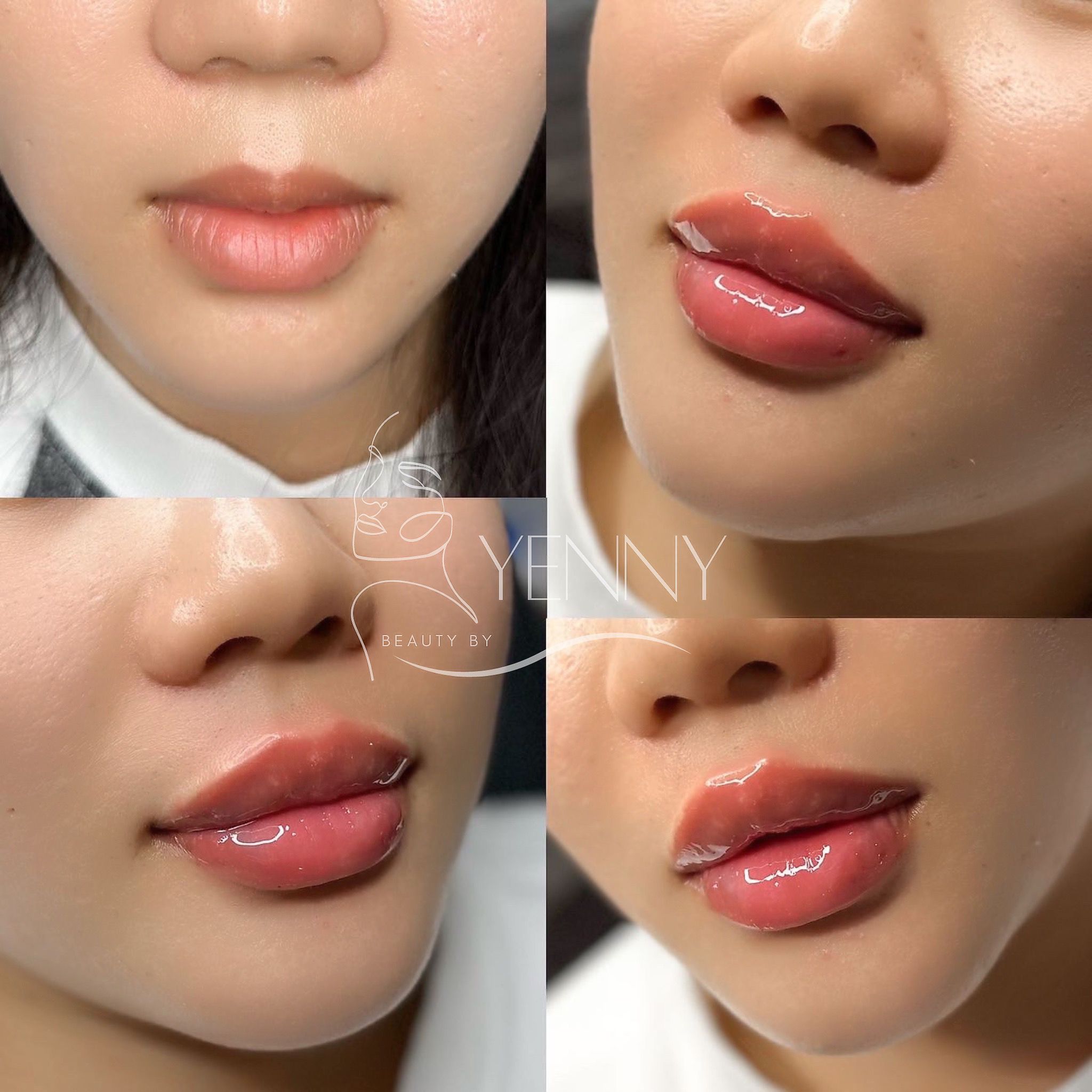 Before and After Lip Filler