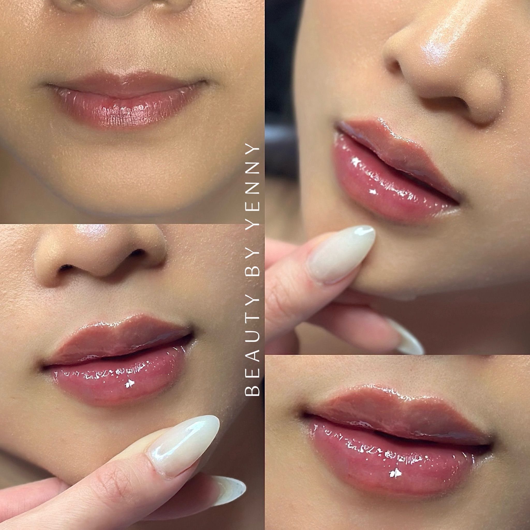 Before and After Lip Filler Treatment